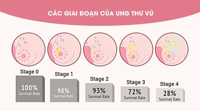 Các giai đoạn của ung thư vú