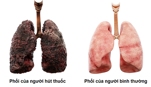 ung-thu-phoi-o-nhung-nguoi-khong-hut-thuoc