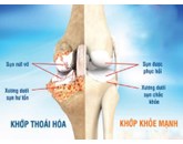 Tập Thể Dục Ngăn Chặn Sự Thoái Hóa Sụn Do Viêm Xương Khớp