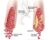 BỆNH XƠ VỮA ĐỘNG MẠCH VÀ NHỮNG ĐIỀU CẦN BIẾT